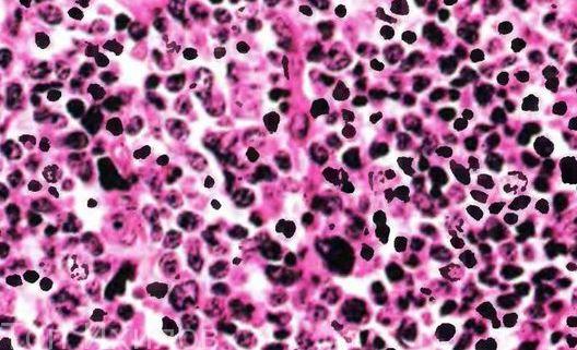 Т-клеточная лимфома