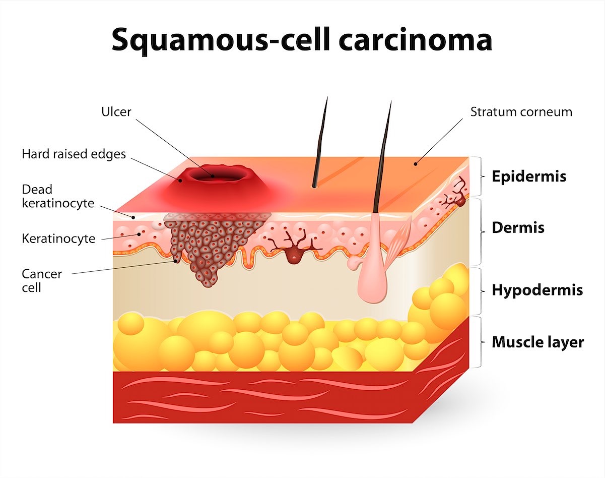 Плоскоклеточный рак кожи