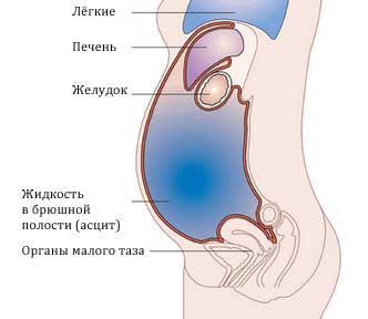 Первичная перитонеальная карцинома