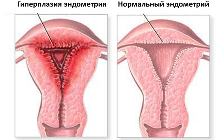 Атипическая гиперплазия эндометрия